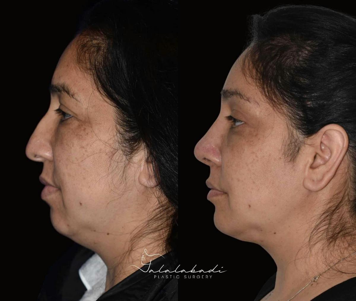 Rhinoplasty Before & After Gallery - Patient 908181 - Image 1