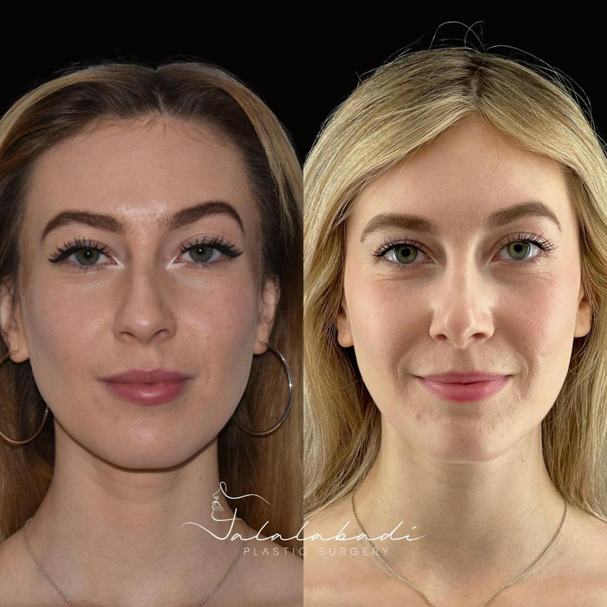 Rhinoplasty Before & After Gallery - Patient 859742 - Image 2