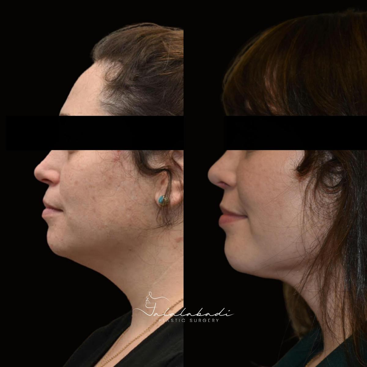 Rhinoplasty Before & After Gallery - Patient 111152 - Image 1