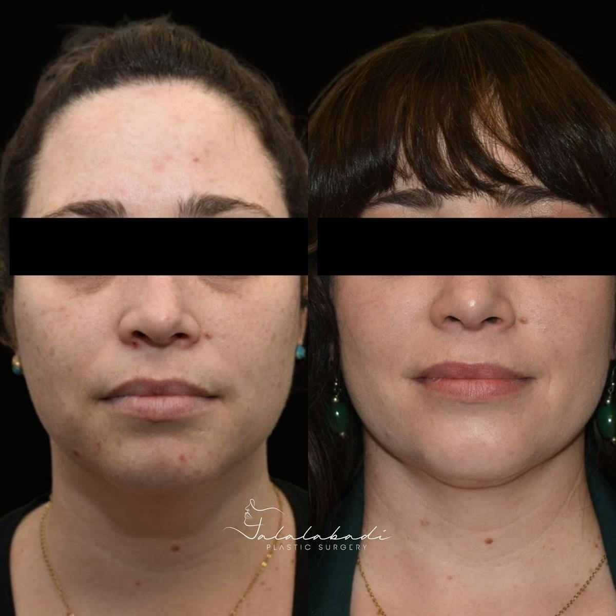 Rhinoplasty Before & After Gallery - Patient 111152 - Image 2