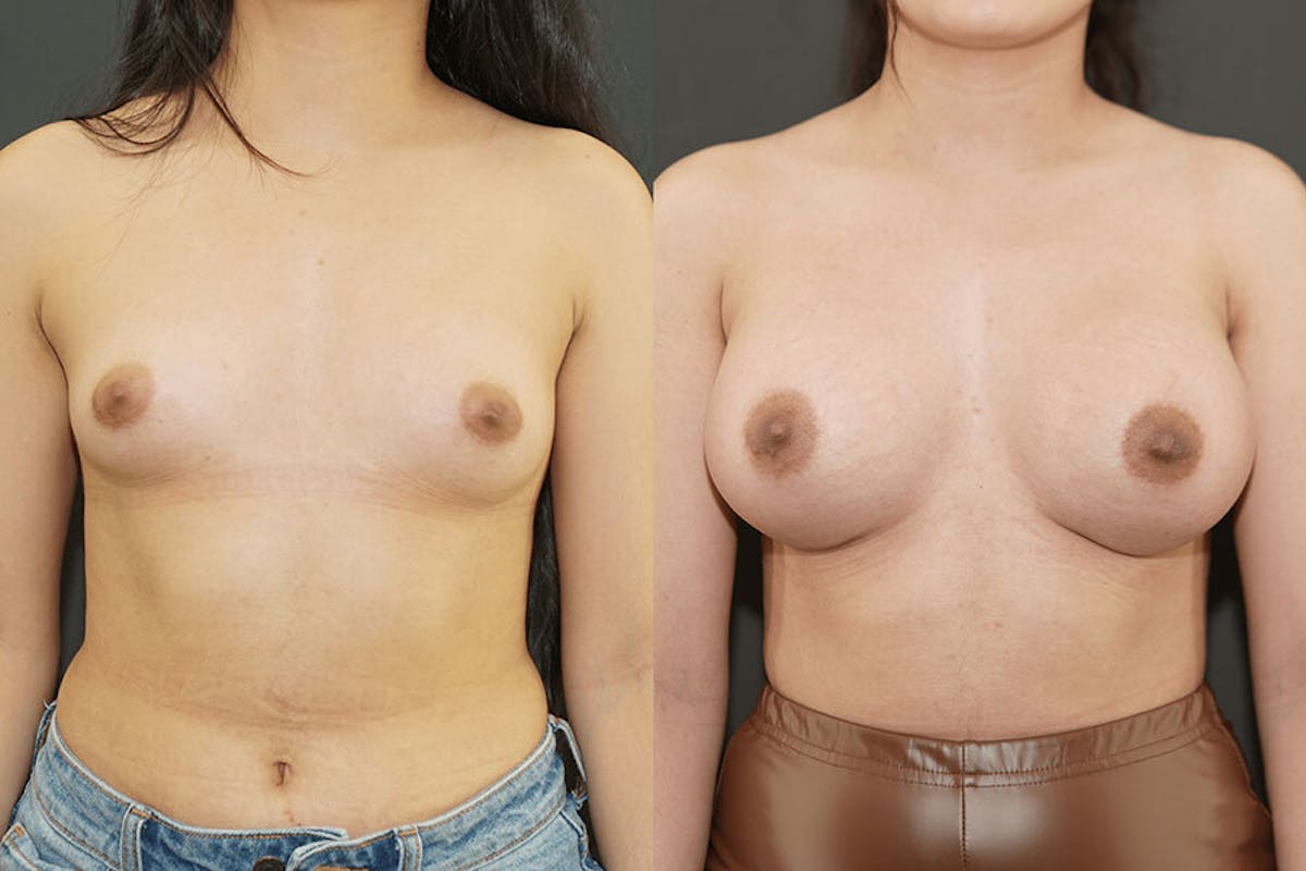 Breast Augmentation Before & After Gallery - Patient 906654 - Image 1