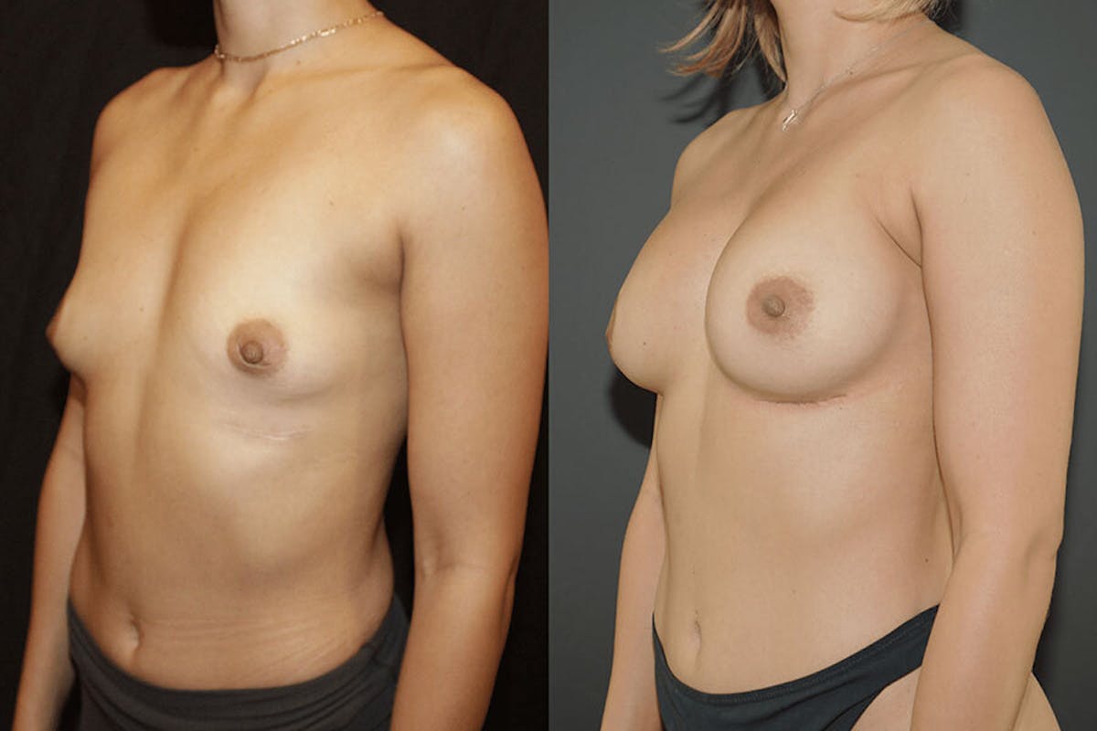 Breast Augmentation Before & After Gallery - Patient 351184 - Image 1