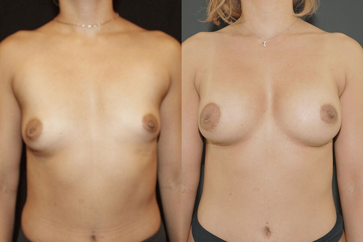 Breast Augmentation Before & After Gallery - Patient 351184 - Image 2