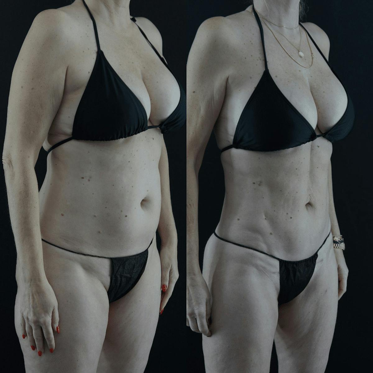 VASER/Hi-Definition Liposuction Before & After Gallery - Patient 335433 - Image 1
