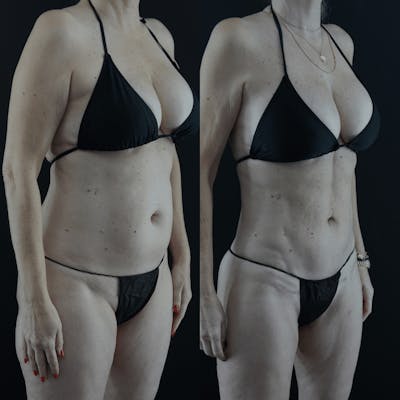 VASER/Hi-Definition Liposuction Before & After Gallery - Patient 335433 - Image 1