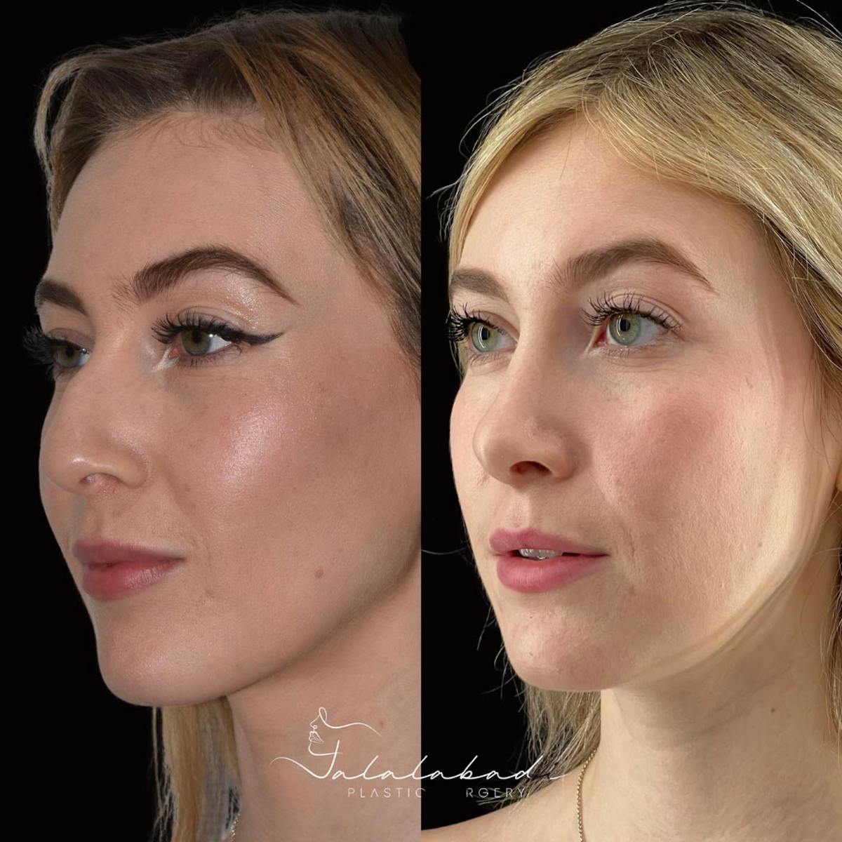 Rhinoplasty Before & After Gallery - Patient 859742 - Image 3