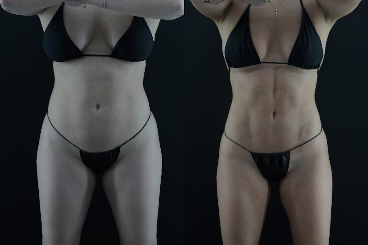 VASER/Hi-Definition Liposuction Before & After Gallery - Patient 397636 - Image 1