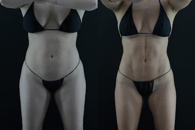 VASER/Hi-Definition Liposuction Before & After Gallery - Patient 397636 - Image 1