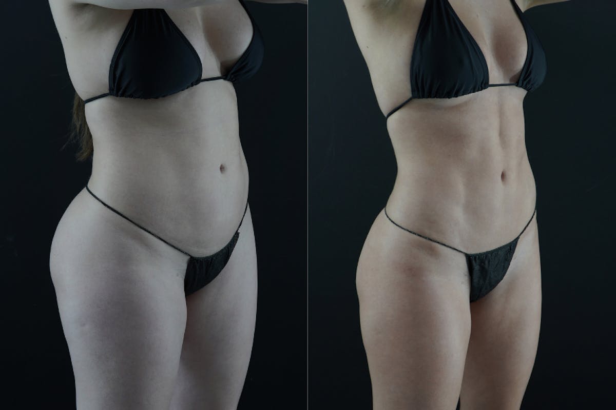 VASER/Hi-Definition Liposuction Before & After Gallery - Patient 397636 - Image 2