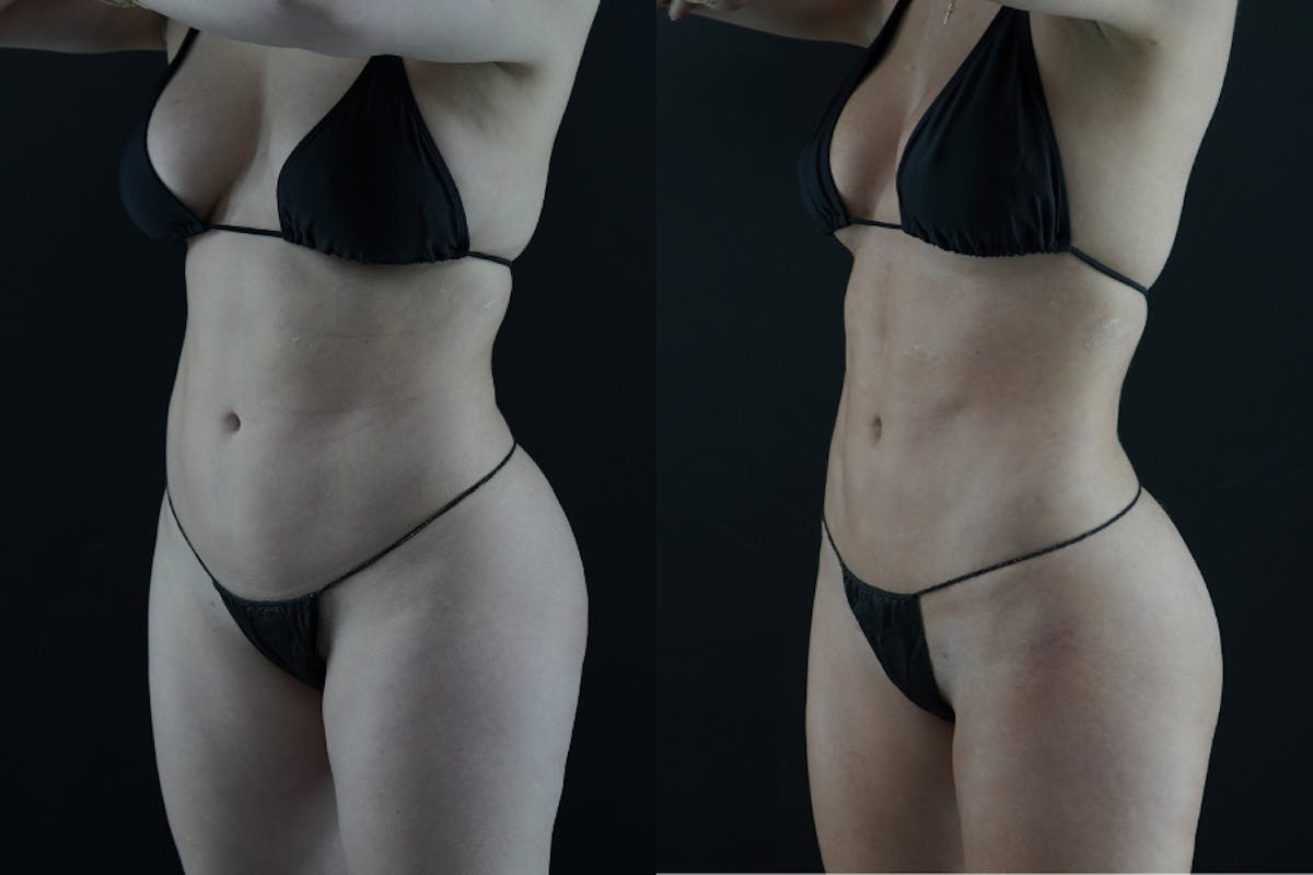 VASER/Hi-Definition Liposuction Before & After Gallery - Patient 397636 - Image 3
