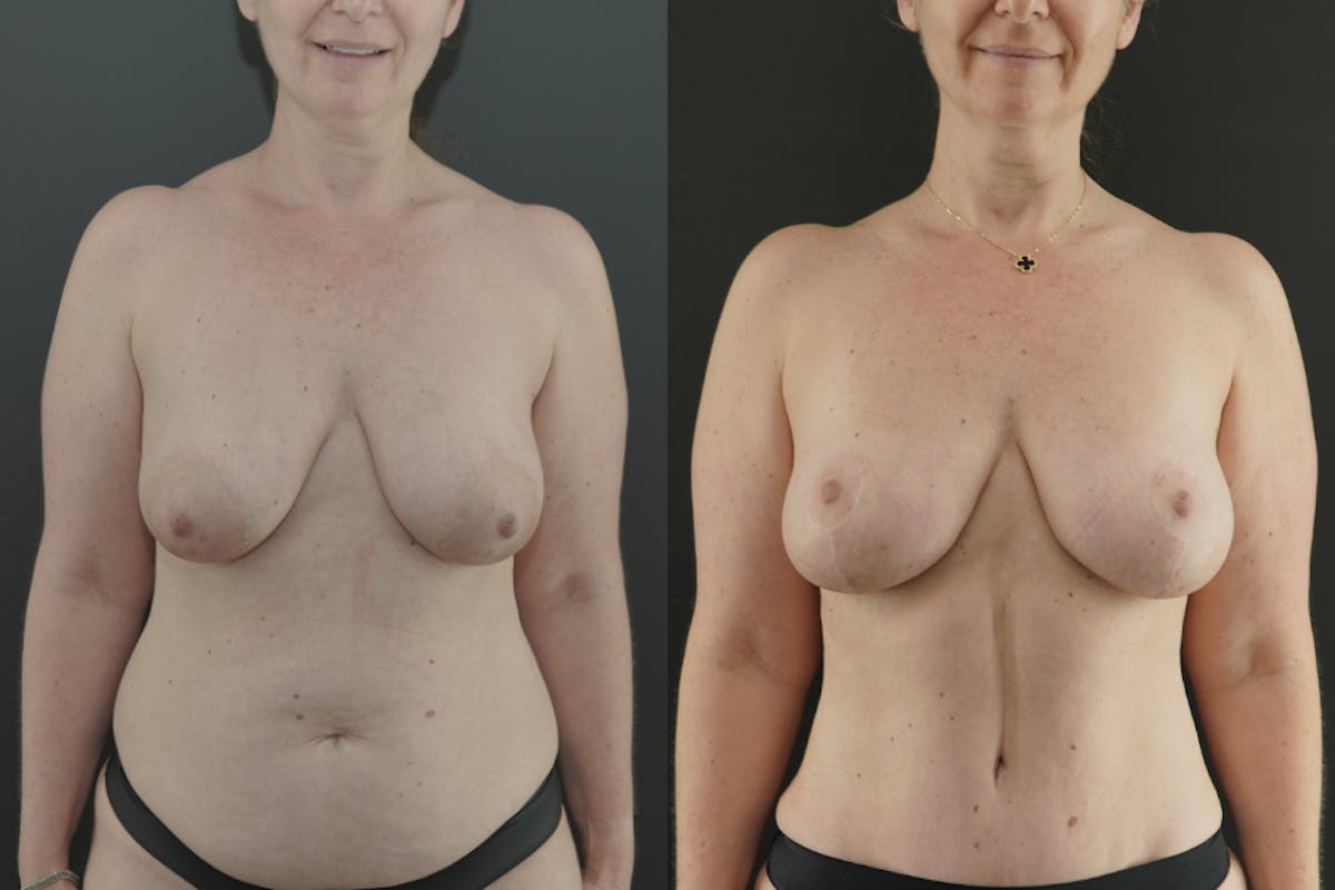 Mommy Makeover Before & After Gallery - Patient 388652 - Image 1