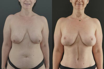 Mommy Makeover Before & After Gallery - Patient 388652 - Image 1