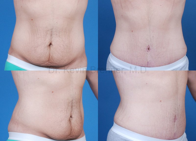 post bariatric tummy tuck