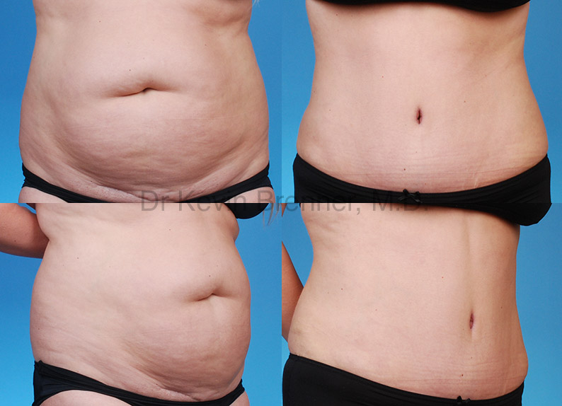 Tummy Tuck After Weight Loss  Post Weight Loss Tummy Tucks