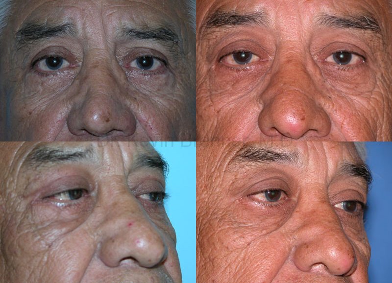eyelid surgery patient before and after