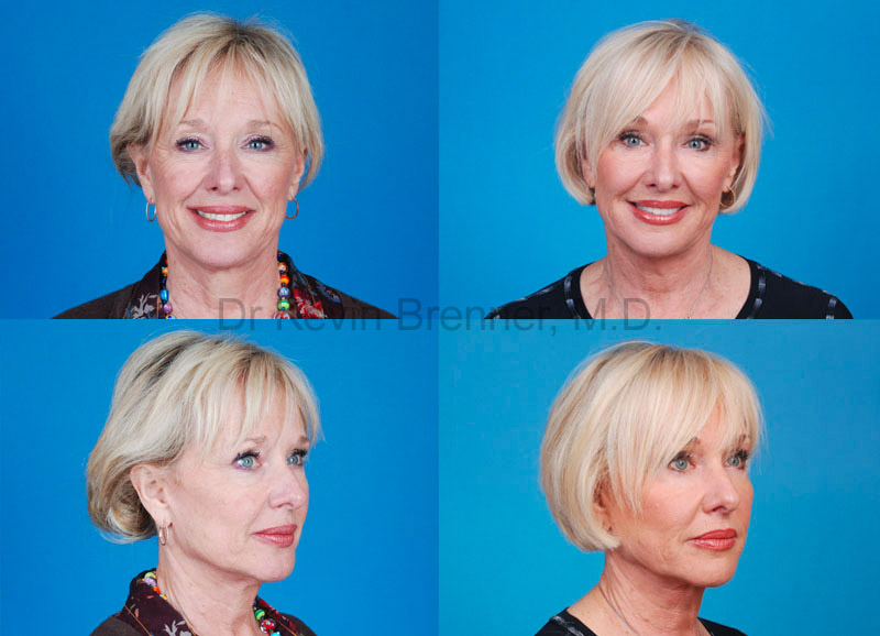 mini facelift patient in Beverly Hills