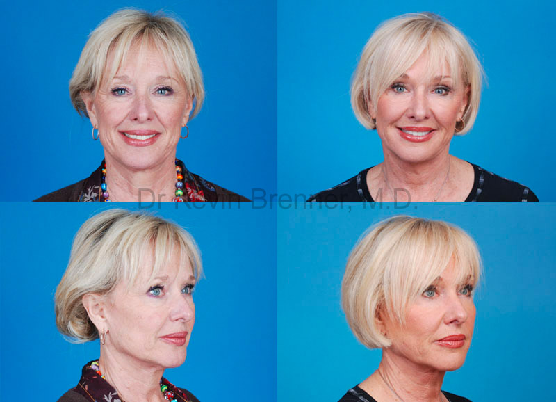 Before and After Facelift in Beverly Hills