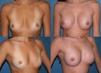 Breast Augmentation Before & After Gallery - Patient 1482261 - Image 1