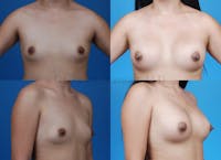 Breast augmentation before and after 2