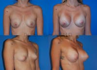 Breast Augmentation Before & After Gallery - Patient 1482265 - Image 1