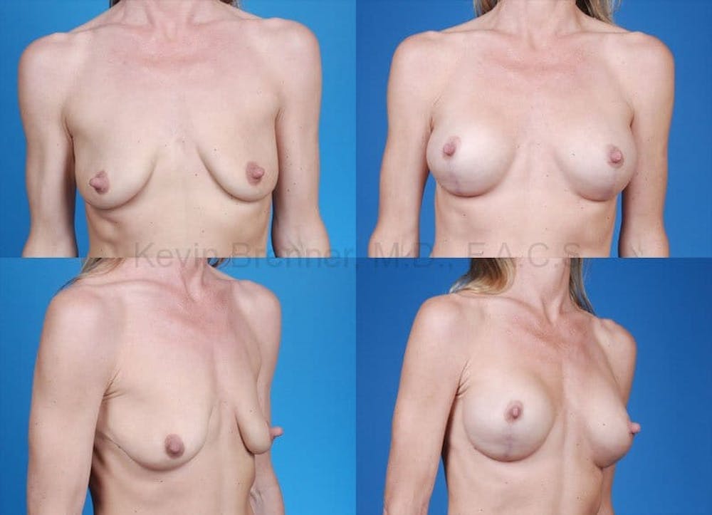 Breast Augmentation Before & After Gallery - Patient 1482268 - Image 1
