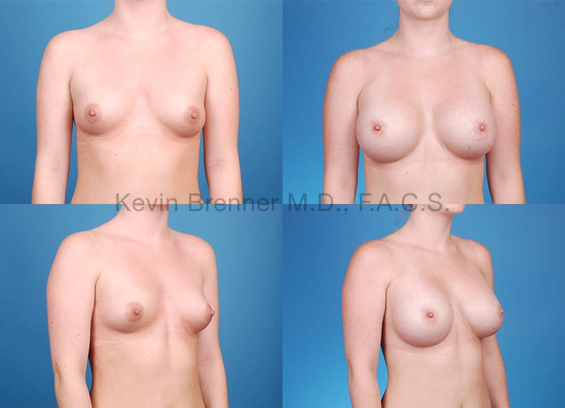 Before and after of a Breast Augmentation in Beverly Hills