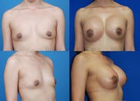 Breast Augmentation Before & After Gallery - Patient 1482273 - Image 1