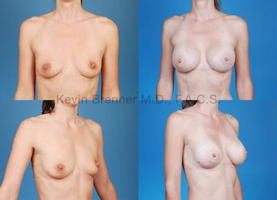 Breast Augmentation Before & After Gallery - Patient 1482275 - Image 1