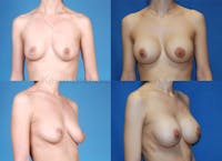 Breast Augmentation Before & After Gallery - Patient 1482277 - Image 1