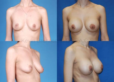 Breast Augmentation Before & After Gallery - Patient 1482277 - Image 1
