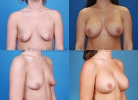 Breast augmentation before and after 4