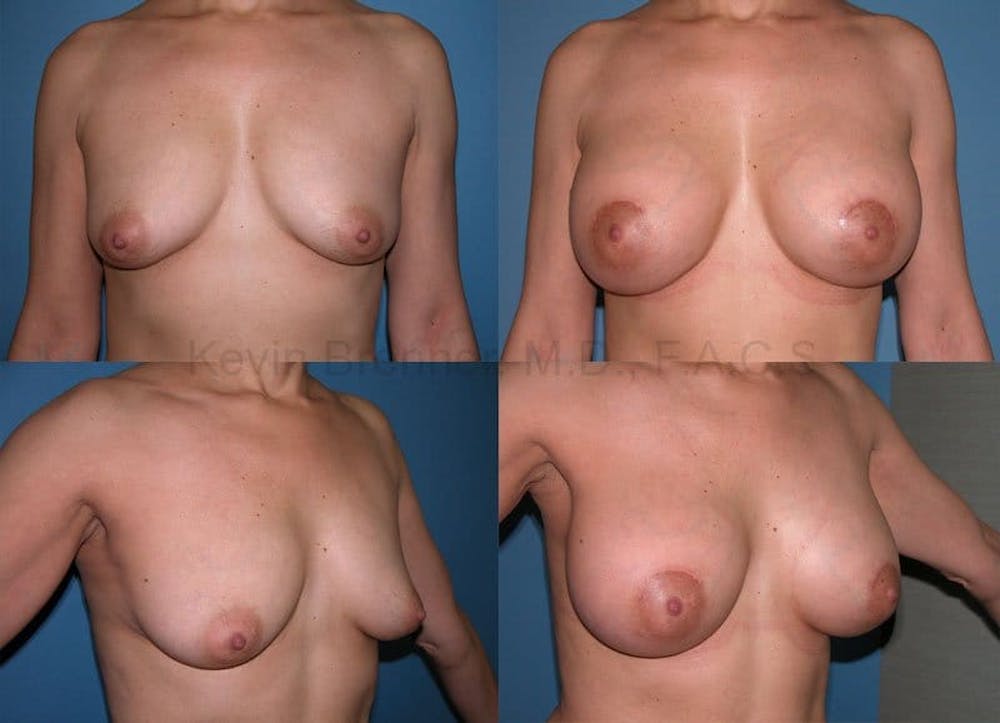 Breast Augmentation Before & After Gallery - Patient 1482280 - Image 1