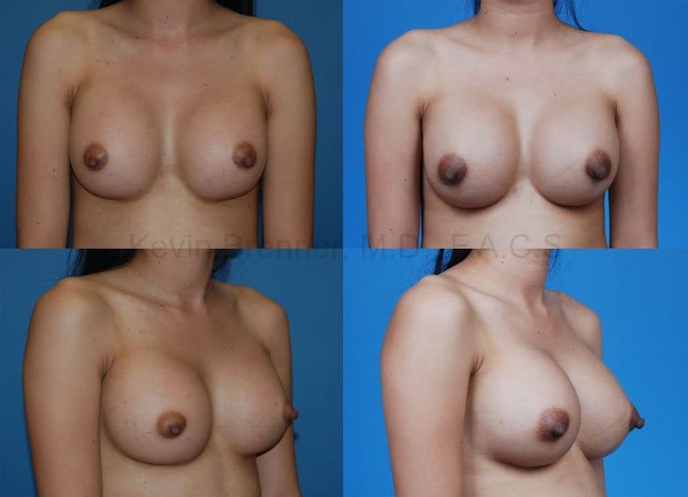 Breast Augmentation Before & After Gallery - Patient 1482282 - Image 1