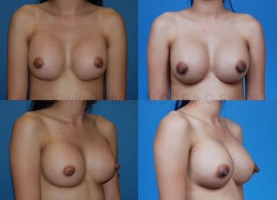 Breast Augmentation Before & After Gallery - Patient 1482282 - Image 1