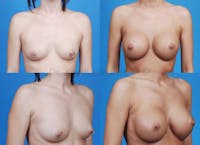 Breast Augmentation Before & After Gallery - Patient 1482288 - Image 1