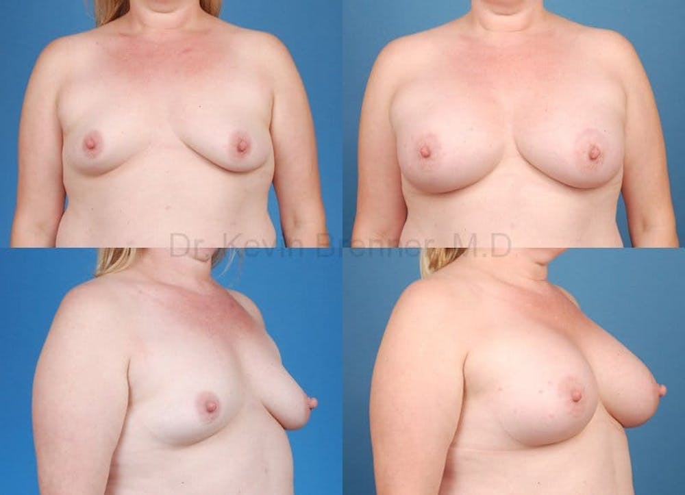 Breast Augmentation Gallery - Patient 1482289 - Image 1