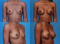 Breast Augmentation Before & After Gallery - Patient 1482291 - Image 1