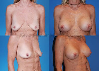 Breast Augmentation Before & After Gallery - Patient 1482302 - Image 1
