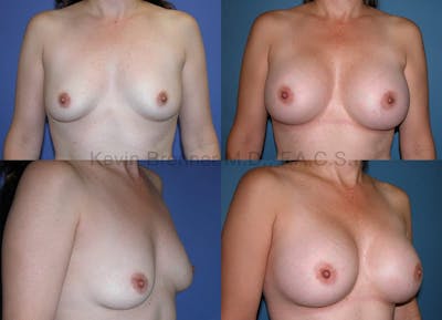Breast Augmentation Before & After Gallery - Patient 1482305 - Image 1