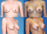 Breast Augmentation Before & After Gallery - Patient 1482307 - Image 1