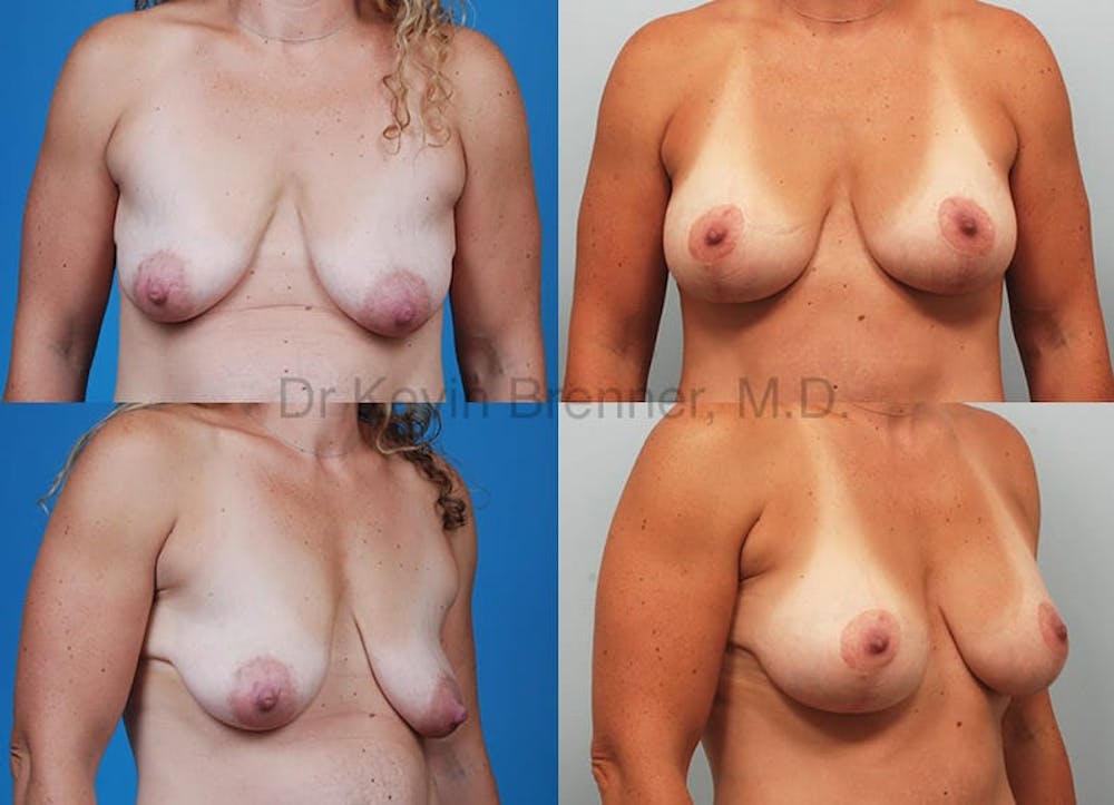 Breast Augmentation Before & After Gallery - Patient 1482308 - Image 1