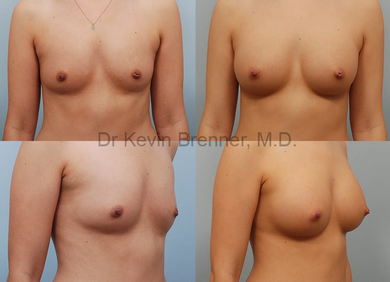 Beverly Hills Breast Implants results