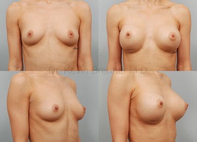 Breast Augmentation Before & After Gallery - Patient 1482311 - Image 1