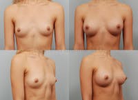 Breast Augmentation Before & After Gallery - Patient 1482312 - Image 1