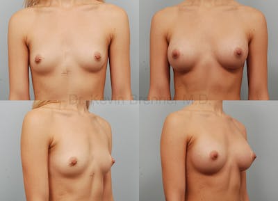 Breast Augmentation Before & After Gallery - Patient 1482312 - Image 1