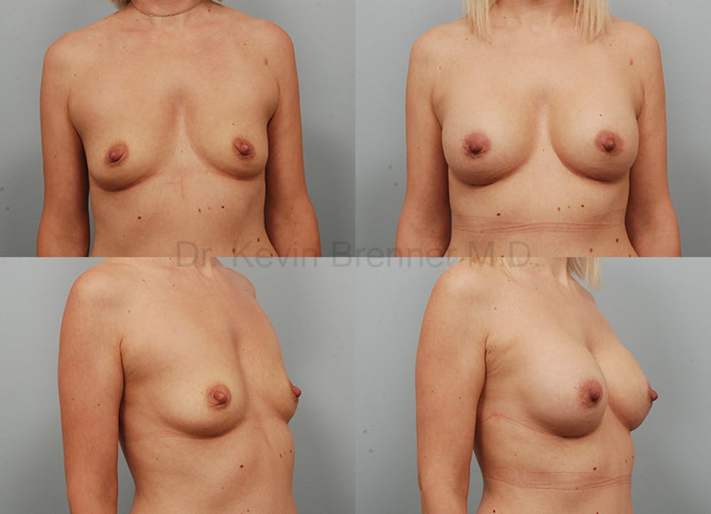 Breast Augmentation Before & After Gallery - Patient 1482314 - Image 1