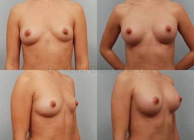 Breast Augmentation Before & After Gallery - Patient 1482315 - Image 1