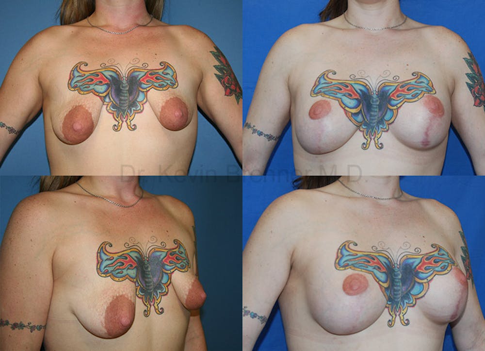 Breast Augmentation Gallery - Patient 1482316 - Image 1