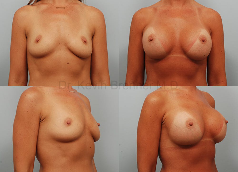 Breast augmentation before and after 5