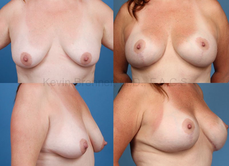 before and after of Breast Lift in Beverly Hills